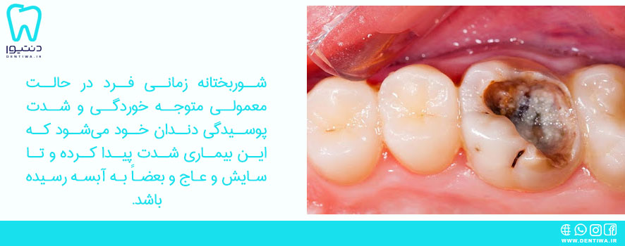 علائم پوسیدگی دندان چیست