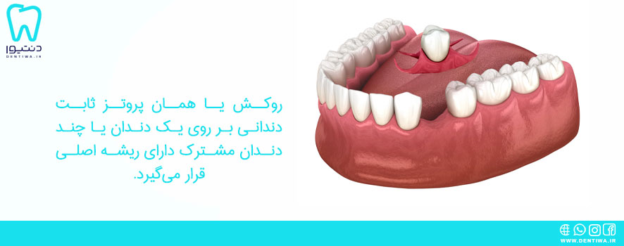 پروتز دندان ثابت
