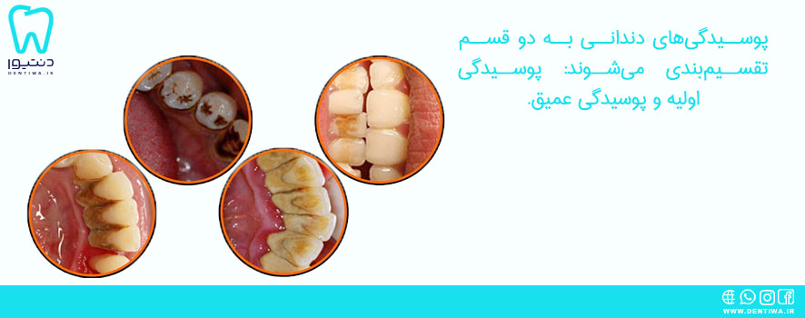 روش تشخیص دندان پوسیده