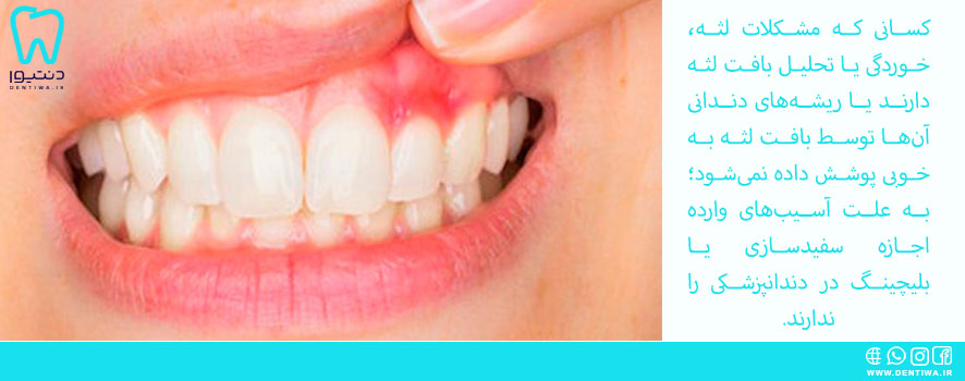 فاکتور های مهم و اصلی بلیچینگ در دندانپزشکی