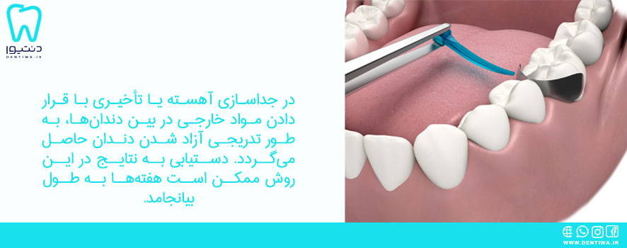 جداسازی دندان‌ها