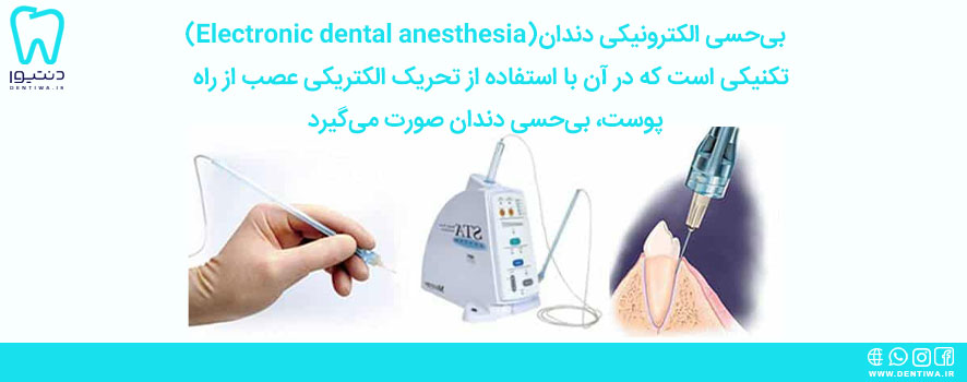 (Electronic dental anesthesia)بی‌حسی الکترونیکی دندان