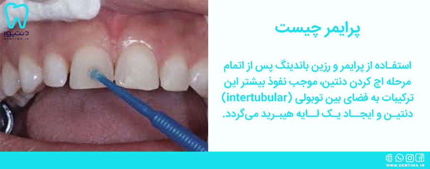 پرایمر دندانپزشکی چیست
