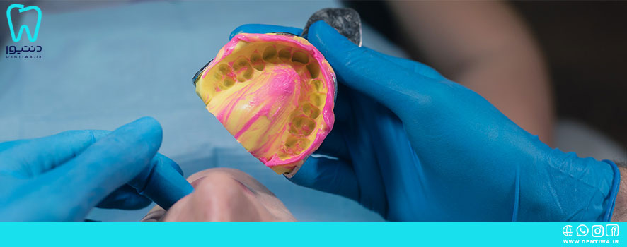 انواع مواد قالبگیری در دندانپزشکی
