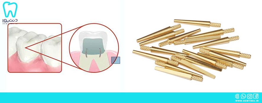 پین دندانپزشکی چیست و چه کاربردهایی دارد؟
