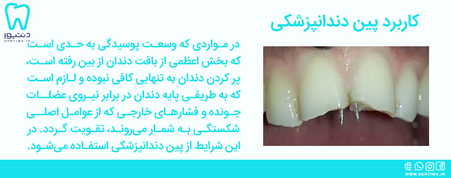 کاربرد پین دندانپزشکی