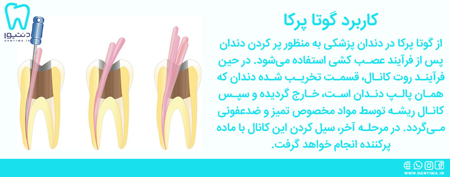 کاربرد گوتا پرکا دندانپزشکی