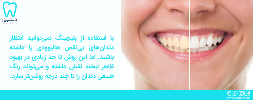 بلیچینگ دندان چه کاربردی دارد