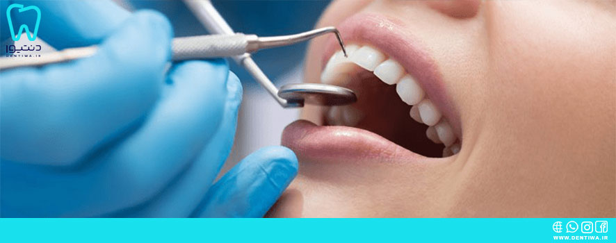 انواع کارور دندانپزشکی
