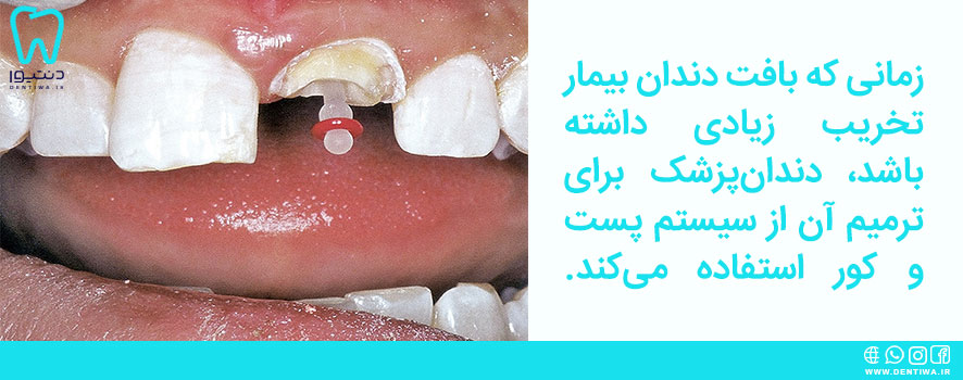 سیستم پست و کور دندان