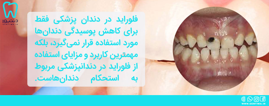 فلوراید برای استحکام دندان ها