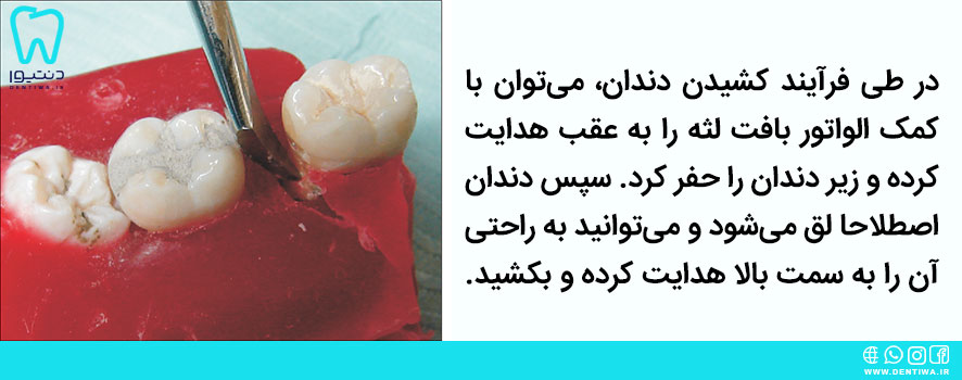 کاربرد الواتور دندان‌پزشکی