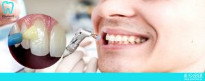 کاربرد فلوراید در دندانپزشکی