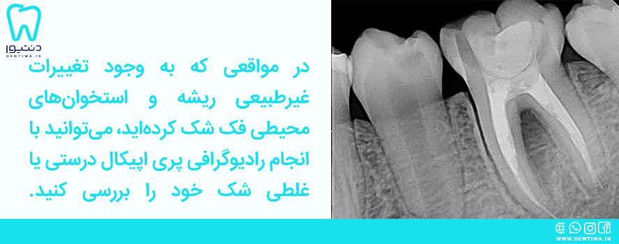 رادیوگرافی پری اپیکال (Periapical) برای مشاهده سمت چپ دندان‌ها