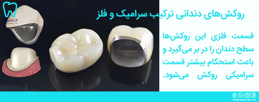 روکش‌های دندانی ترکیب سرامیک و فلز