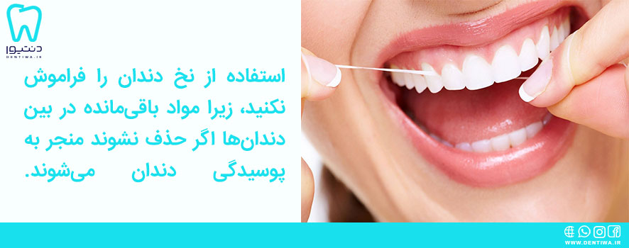 نخ دندان برای مراقبت از لمینت دندان