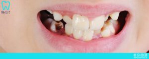برای پوسیدگی دندان چه باید کرد