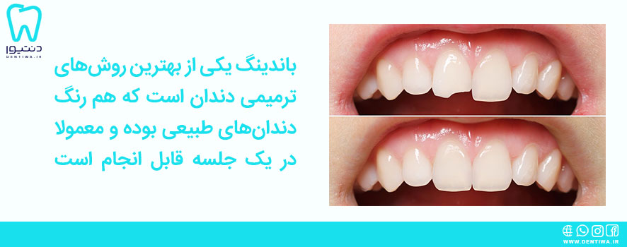 باندینگ دندان چیست