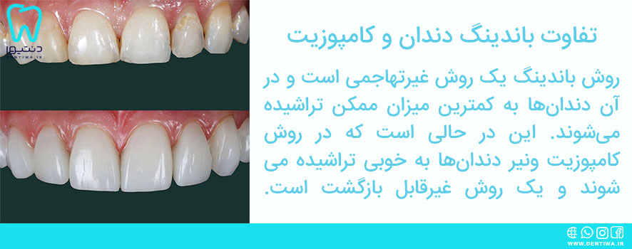 تفاوت باندینگ دندان و کامپوزیت