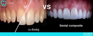 تفاوت باندینگ و کامپوزیت دندانپزشکی