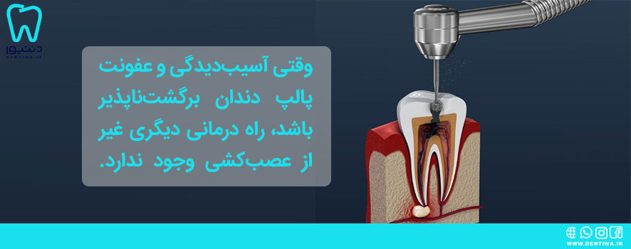 چه زمانی عصب کشی دندان لازم است؟