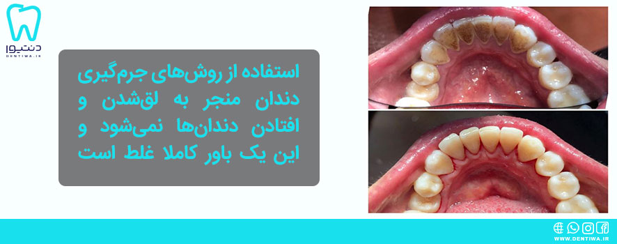 مزایای روش‌های جرم‌گیری دندان
