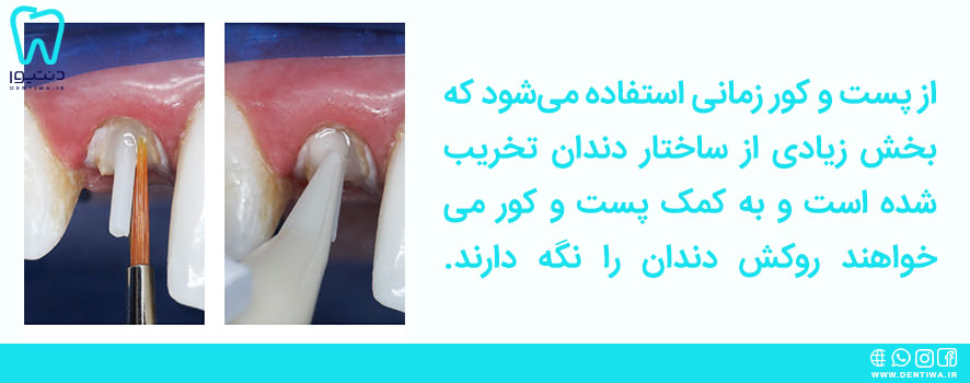 کاربرد پست و کور دندان