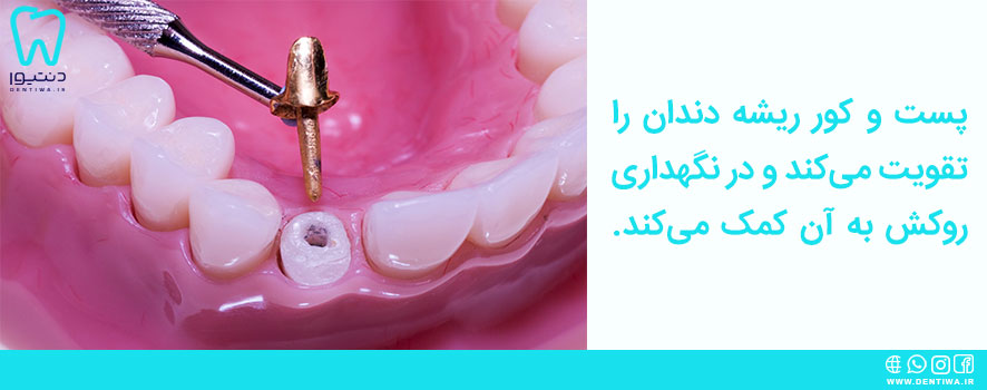 پست و کور دندان چه کاربردی دارند