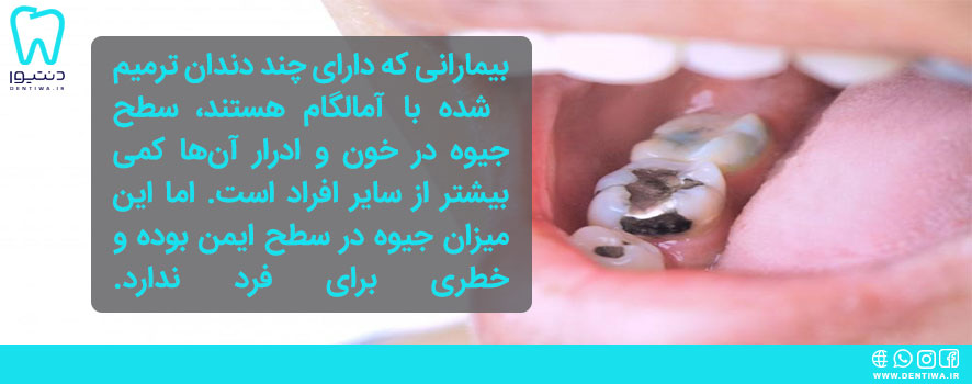 پر کردن دندان با امالگام دندانپزشکی