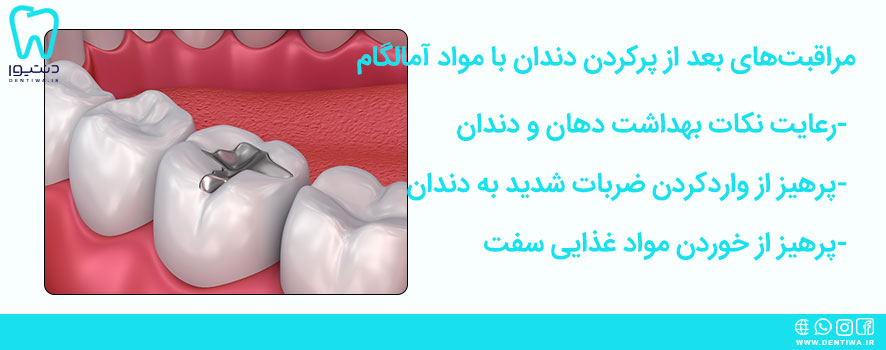 مراقبت‌های بعد از پرکردن دندان با مواد آمالگام