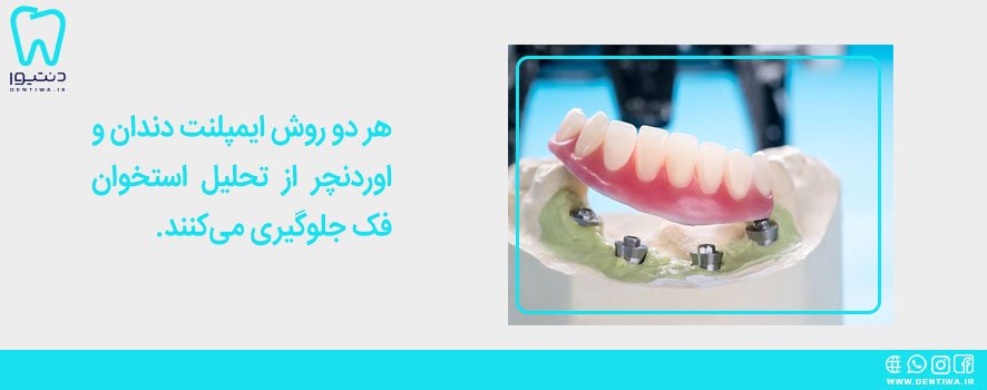 مزایای اوردنچر دندانپزشکی چیست؟