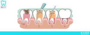 آبچوریشن دندان چیست