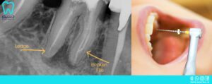خارج کردن فایل شکسته شده در کانال دندان
