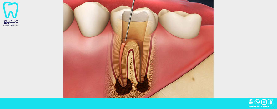 علت و درمان کلسیفیته شدن کانال دندان