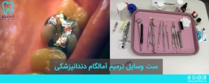 ست وسایل ترمیم آمالگام دندانپزشکی