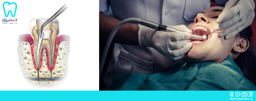 کنترل دقیق رطوبت حین درمان ریشه